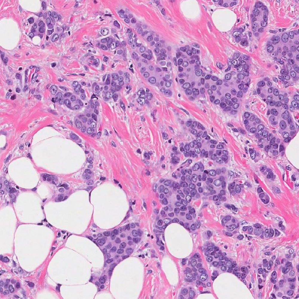 Dcis Ductal Carcinoma In Situ Dr Radhika Breast Clinic